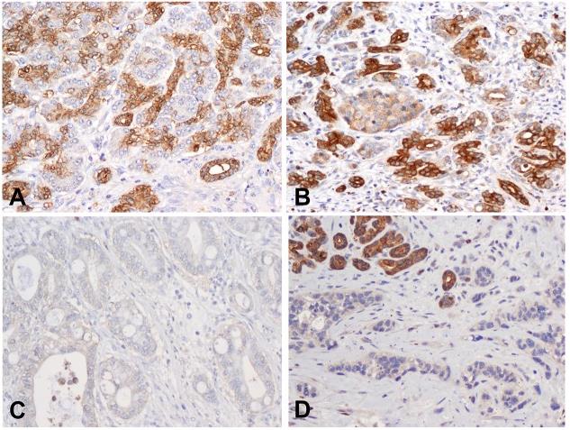 Expression of MAP4K5 in non-neoplastic pancreas and pancreatic ductal adenocarcinoma samples.jpg